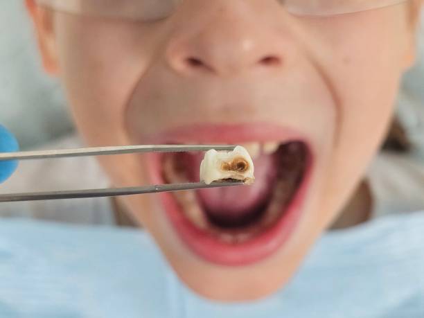Best Emergency Dental Care for Broken or Chipped Teeth in Taylorsville, UT