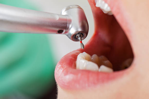 Best Emergency Treatment for Dental Infections or Abscesses in Taylorsville, UT